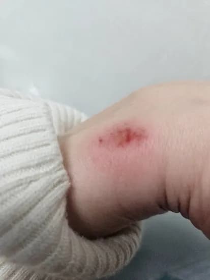 고데기 폭팔 화상