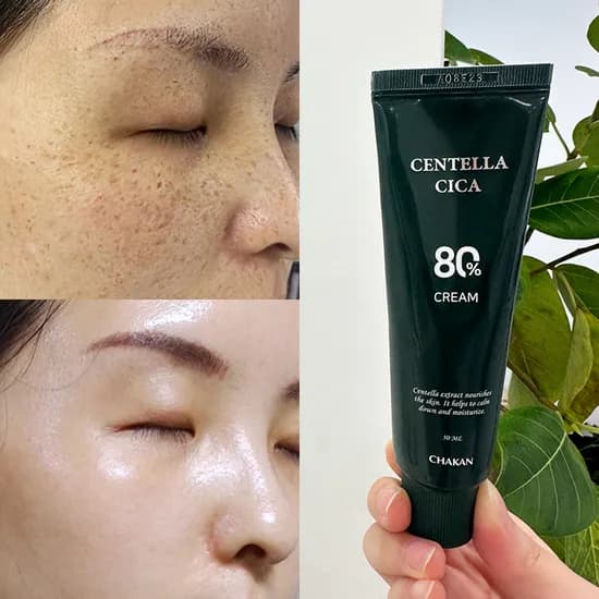 센텔라시카 80프로 기미비립종 크림 50ml 5개
