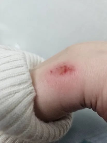 고데기 폭팔 화상